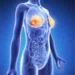 3d rendered illustration - breast cancer