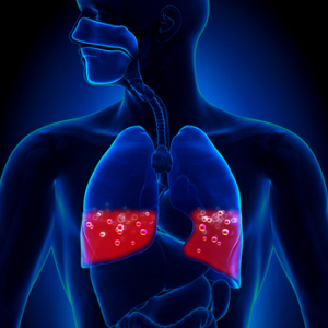 pulmonary-embolism