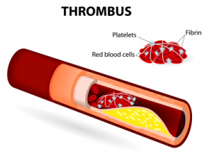 venous-thomboembolism