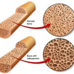 osteoporosis