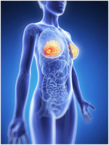 calcium reduces breast cancer risk