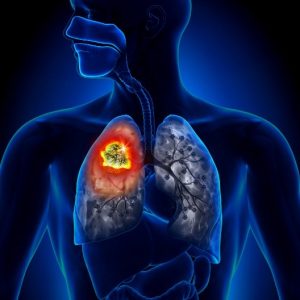 do b vitamins cause lung cancer in men answer