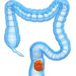 colon cancer prevention colorectal