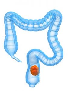 colon cancer intestines