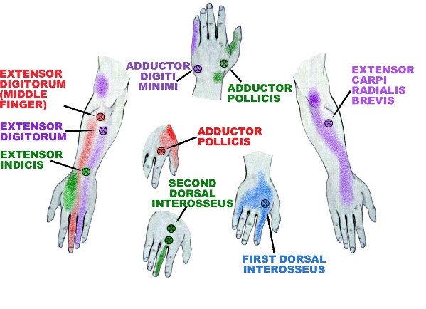 Relief From Carpal Tunnel Pain Without Surgery - Health Tips From The ...