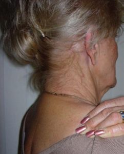 Treating Levator Scapulae Muscle 