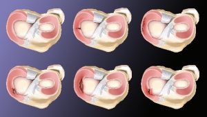 Meniscus